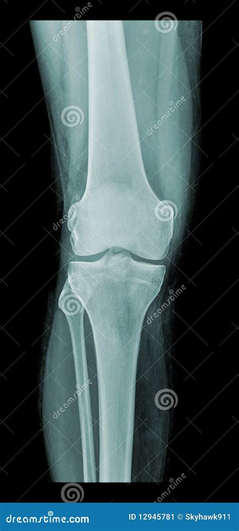 Knee X-ray Stock Image - Image: 12945781