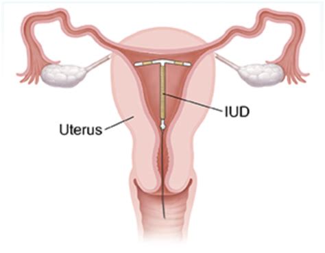 Which Of The Following Is A Hormone Releasing Intrauterine Device Iud