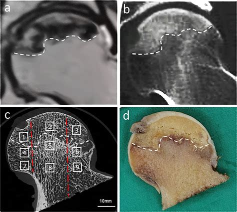 Frontiers Less Sclerotic Microarchitecture Pattern With Increased