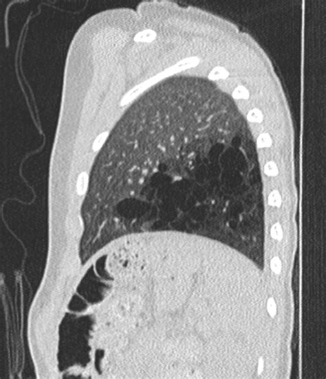 Congenital Pulmonary Airway Malformation Article