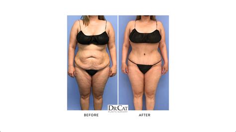 Amazing Transformation After A Tummy Tuck With Pubic Lift And Liposuction Of The Mons Pubis