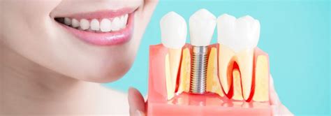 Understanding Basal Implants Dr Motiwala Dental Clinic In India