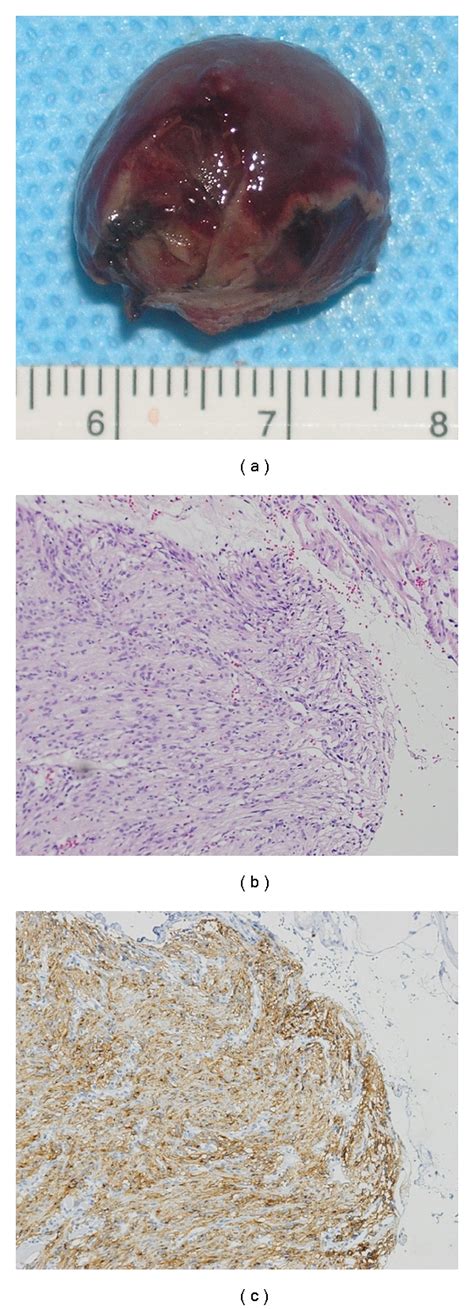 A Macroscopic View Resected Tumor Was Mm In Diameter