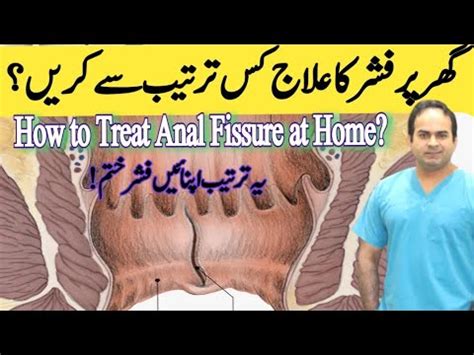 Anal Fissure Treatment Non Surgical Options GTN Warm Sitz Bath Shower Ispaghola Husk