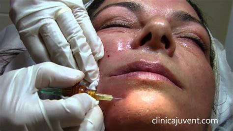 Carboxiterapia Facial Youtube