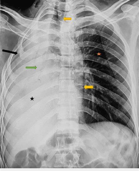 Preoperative Chest X Ray Posteroanterior View The Image Shows Diffuse