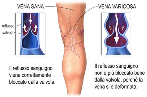 Varici Delle Gambe E Chirurgia Vascolare Patologie Di Vene Ed Arterie