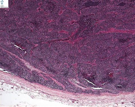 Desmoplastic Small Round Cell Tumor Humpath Human Pathology