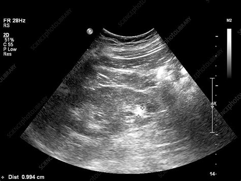 Gallstone Ultrasound Scan Stock Image C0177857 Science Photo