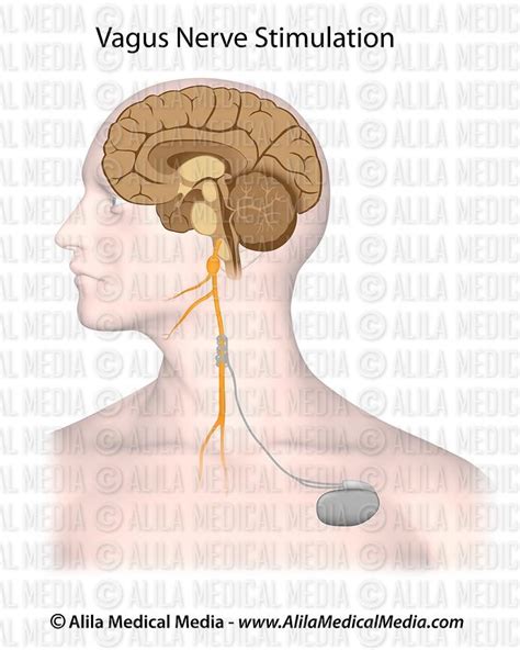 Alila Medical Media Stimulation Du Nerf Vague Illustration M Dicale