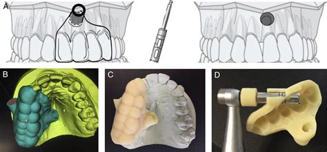 Targeted Endodontic Microsurgery A Novel Approach To Anatomically Challenging Scenarios Using 3