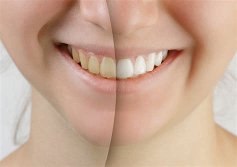 El blanqueamiento dental daña los dientes Mejor con Salud