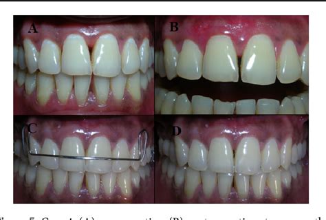 Figure From Surgical Reconstruction Of Interdental Papilla Using