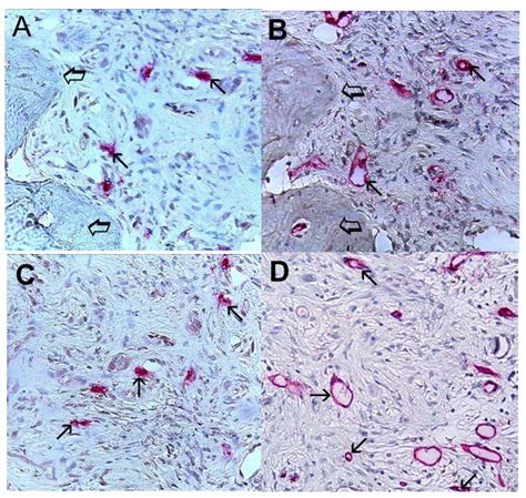 IJMS Free Full Text Infiltrating Mast Cells Correlate With