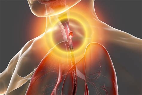 Study Barretts Esophagus Always Precedes Esophageal Cancer Inside