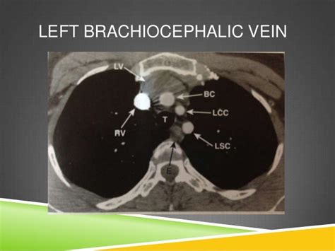 Ct Anatomy Of Normal Mediastinum Made Easy