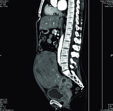 Ct Scan Of A Large Abdominopelvic Mass Showing Uneven Density