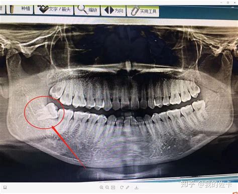 拔智齿全过程 知乎