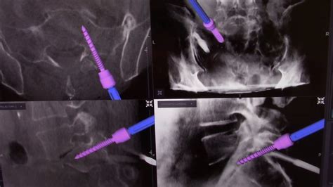 Difference Between Spondylosis And Spondylolysis Spondylosis Vs