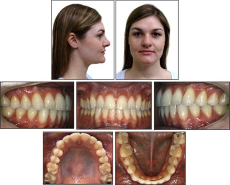 Extraoral And Intraoral Photographs After Retention For 8 Years Download Scientific Diagram