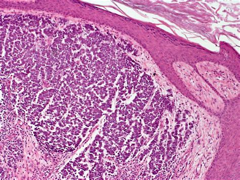 Merkel Cell Carcinoma Histology