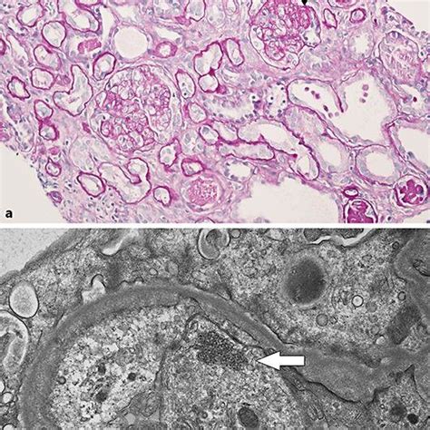 Renal Biopsy Findings For Case A Three Glomeruli With Focal And