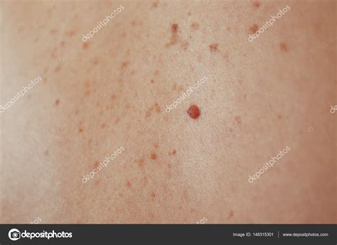 Human Skin With Birthmarks — Stock Photo © Belchonock 148315301