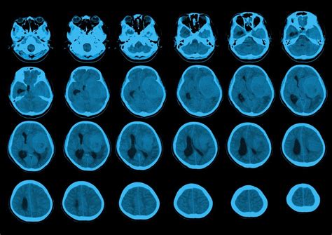 What is Meningioma Symptoms Diagnosis Treatment