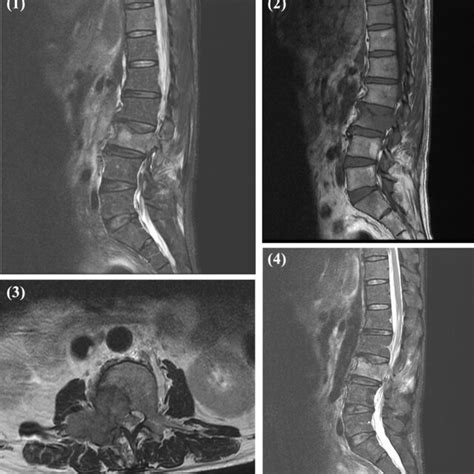 Magnetic Resonance Imaging In This Case 1 Sagittal View T2 Weighted Download Scientific