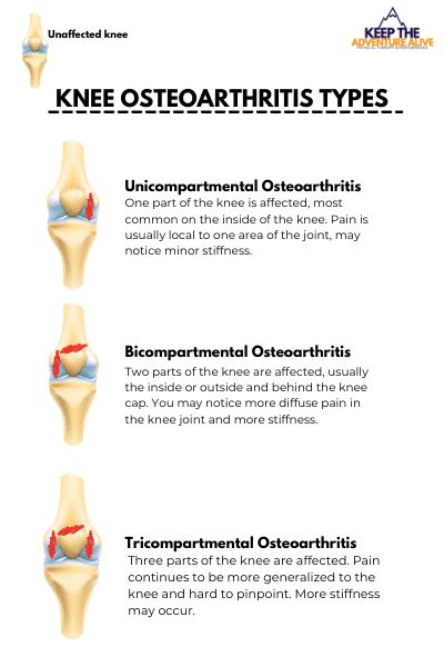 Guide To Severe Knee Arthritis Tricompartmental 51 Off