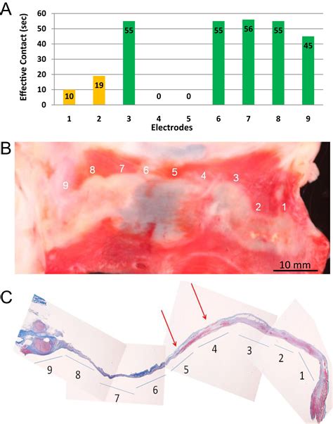 Predictability Of Lesion Durability For Af Ablation Using Phased