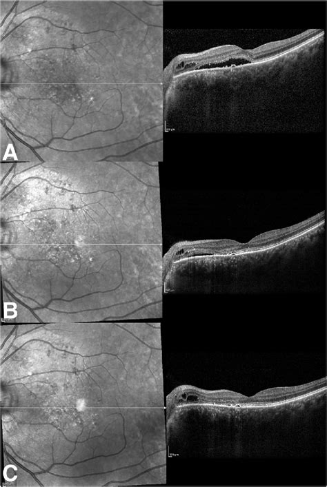 Spectral Domain Optical Coherence Tomography Angiography SD OCT