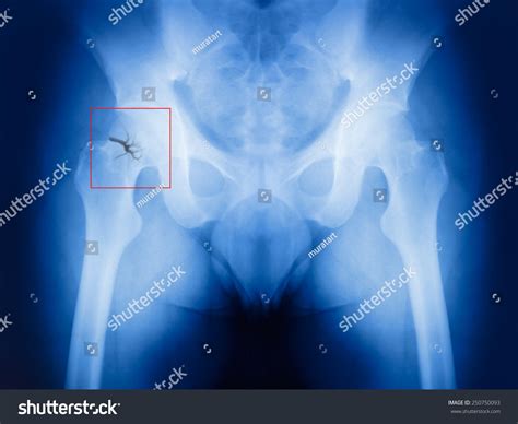 Xray Broken Hip Stock Photo (Edit Now) 250750093