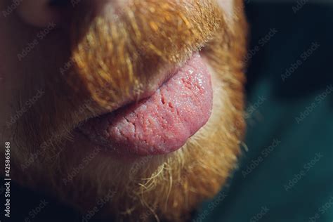 Bacterial infection disease tongue in a man. Stock Photo | Adobe Stock