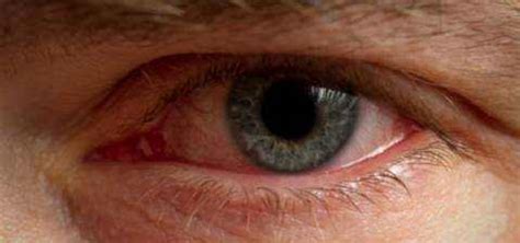 Allergic Conjunctivitis: Causes, Symptoms and Treatment