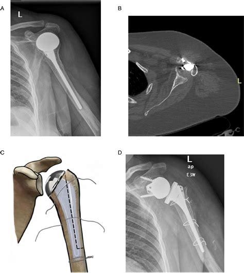 Reverse Shoulder Arthroplasty For Failed Operative Treatment Of Proximal Humeral Fractures