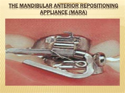 Fixed Functional Appliancesdental Courses