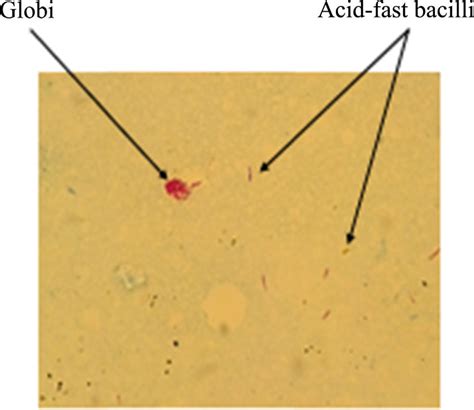 M Leprae Acid Fast Bacilli Isolated Or Grouped In Globi Following Download Scientific