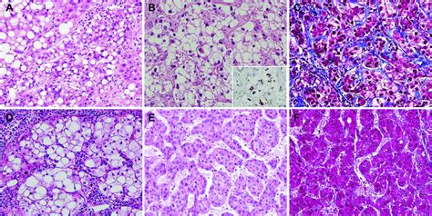 Pathological Features Of The Steatohepatitic Hepatocellular Carcinoma Download Scientific