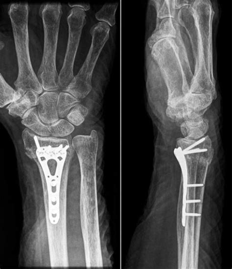 One Of The Difficulties In Surgical Management Of Colles Fracture