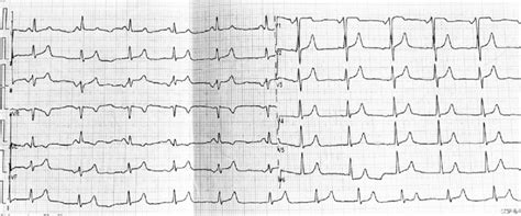 Ecg Showed A Coronary Sinus Rhythm With A Heart Rate At Beats Per