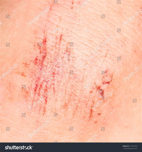 wound  skin close  stock photo  shutterstock