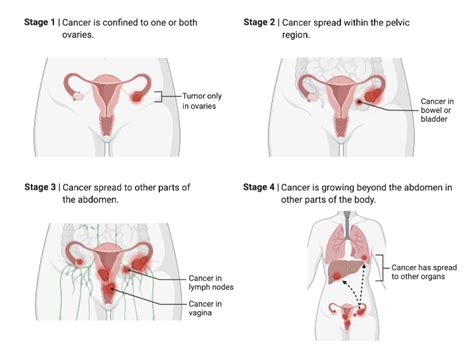 Ovarian Cancer Stages