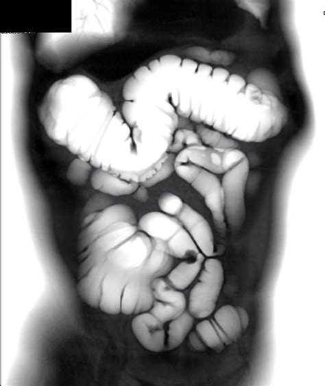 Collection 102 Pictures What Do Polyps Look Like In The Colon Sharp