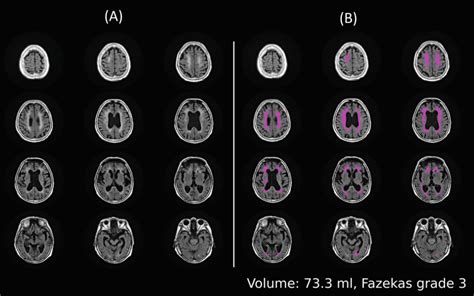 Fig 6 Example Of White Matter Hyperintensity Machine Learning