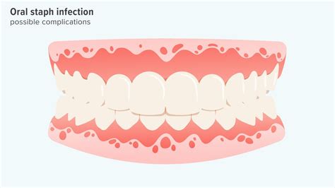 Staph Infection In Mouth Symptoms Causes And Treatment