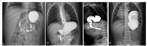 Different Patterns Of Gastric Abnormalities A Gastric Organoaxial Download Scientific Diagram