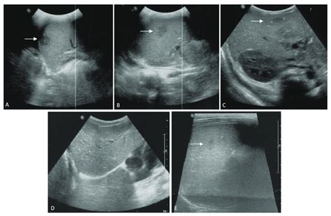 Liver And Spleen Ultrasound Scans Of The Patient On Admission A C And Download Scientific