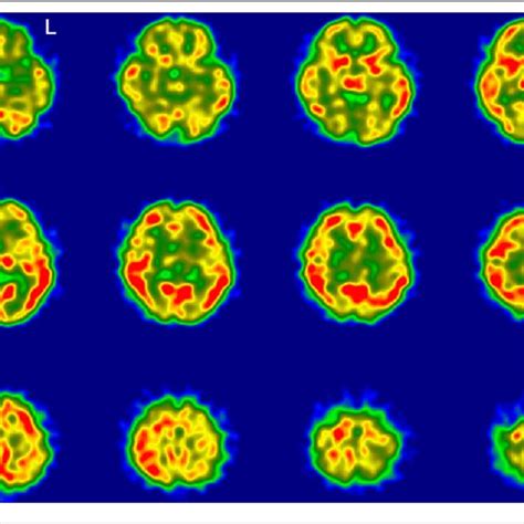 Regional Cerebral Blood Flow Imaging Using Single Photon Emission