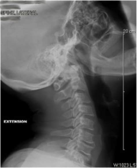 Cervical Myelopathy | OrthoManhattan